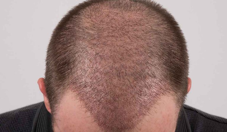 بعد زراعة الشعر بشهر