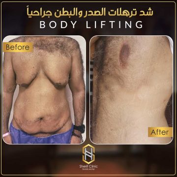 عملية شد البطن قبل وبعد