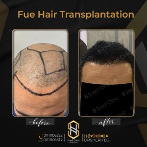 تقنية FUE Smart Implanters