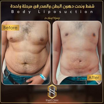 اضرار عملية نحت الجسم