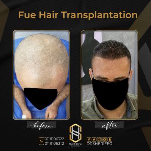 بعد زراعة الشعر