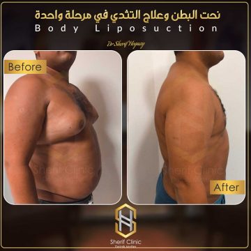 عمليات نحت الجسم قبل وبعد
