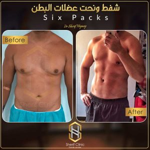 اضرار عملية نحت الجسم