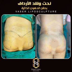 تجارب حقن المؤخره بالدهون الذاتيه