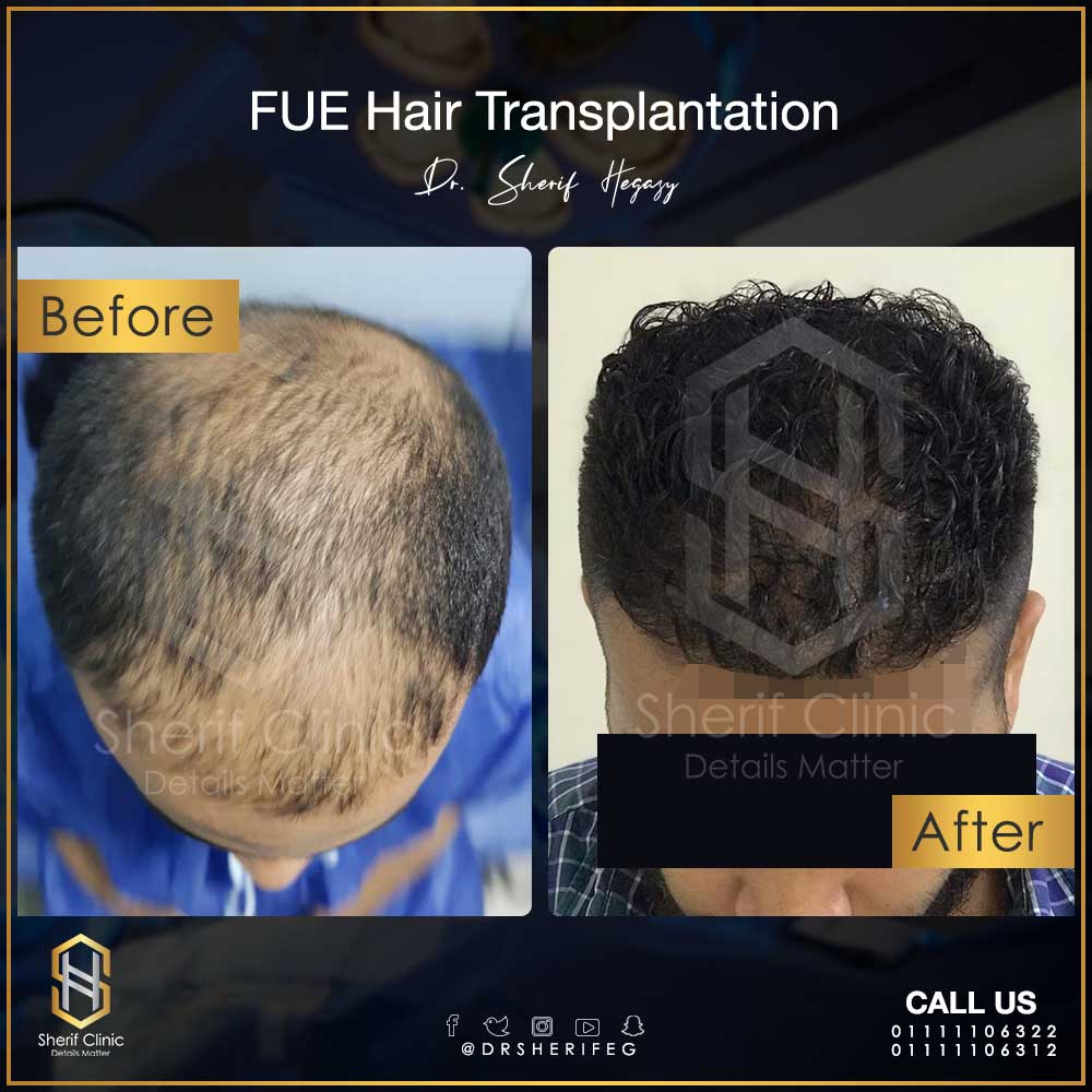 نتيجة توضيحية لزراعة الشعر الطبيعي بالاقتطاف فى مرحلة واحدة عملية زراعة الشعر