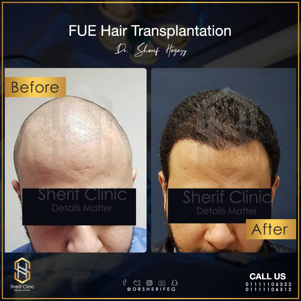 نتيجة لزراعة الشعر الطبيعي للرجال بعد مرور 8 شهور عملية زراعة الشعر
