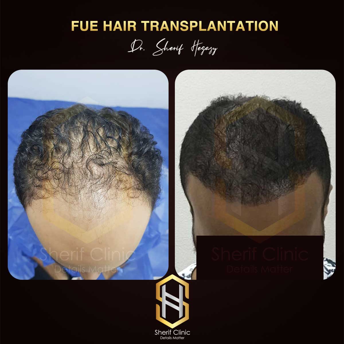 زراعة الشعر للرجال زراعة الشعر للرجال