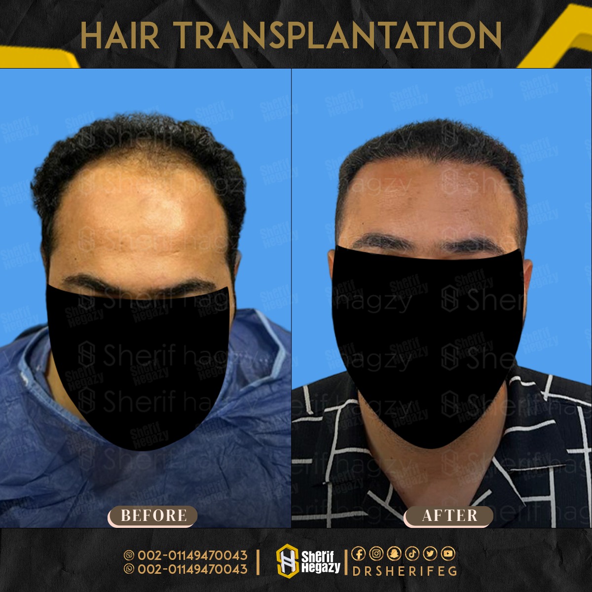 زراعة-الشعر-الطبيعي