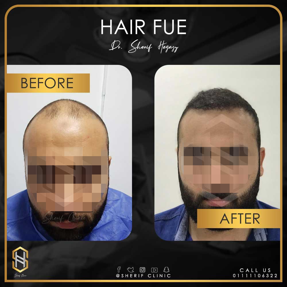 زراعة الشعر الطبيعي