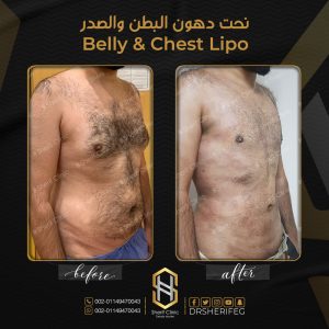 الفرق بين شفط الدهون العادي والفيزر
