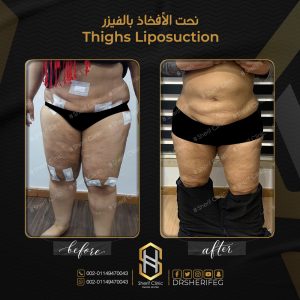 شفط الفخذين بالفيزر