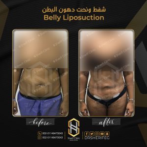 لبس المشد بعد عملية شفط دهون البطن
