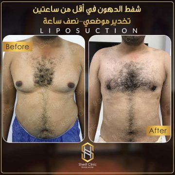 التخدير فى عملية شفط دهون البطن