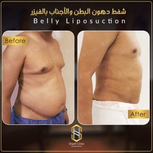 تجربتي مع الفيزر