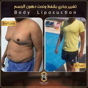 تجربتي مع شفط دهون البطن
