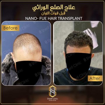 فيناسترايد للشعر