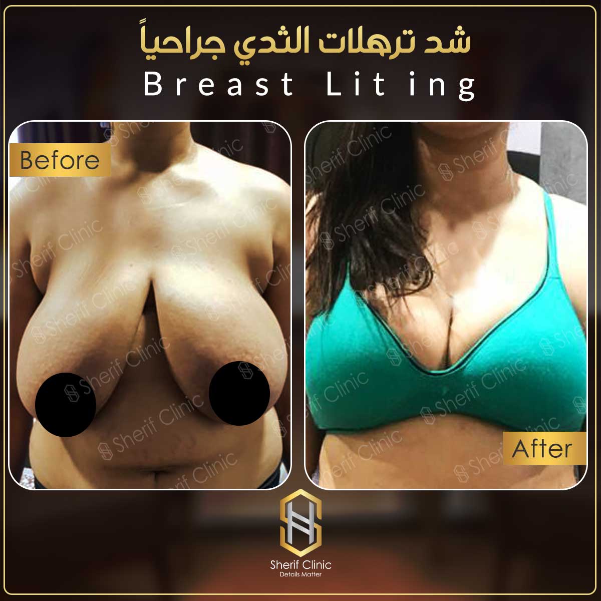 شد الثدي ورفعه