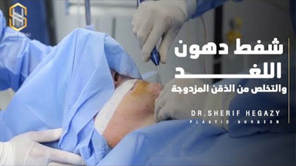 شفط دهون اللغد