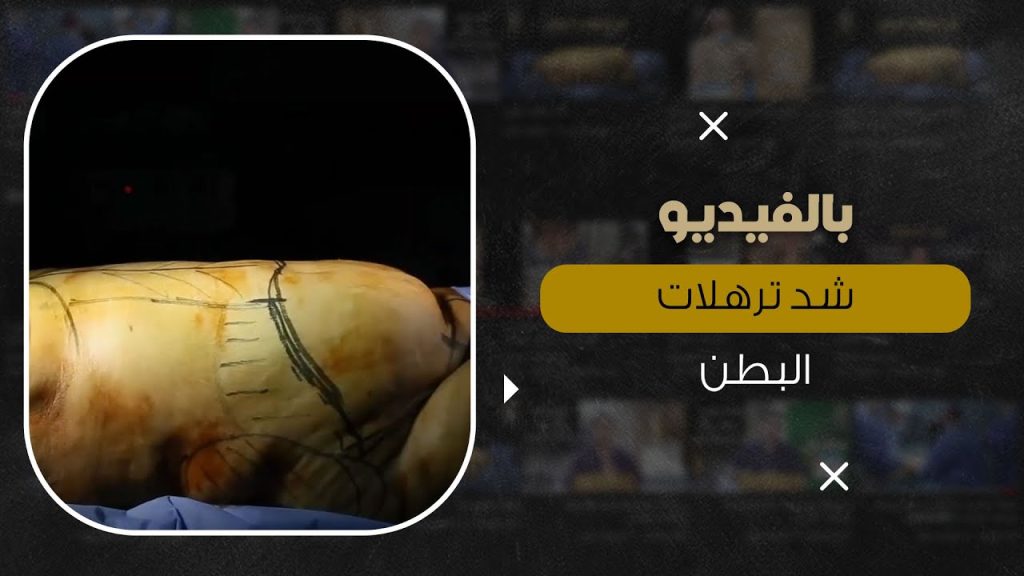 أسباب ترهلات الجسم