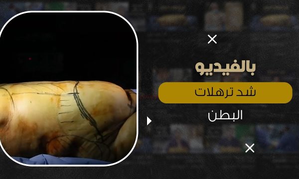 أسباب ترهلات الجسم