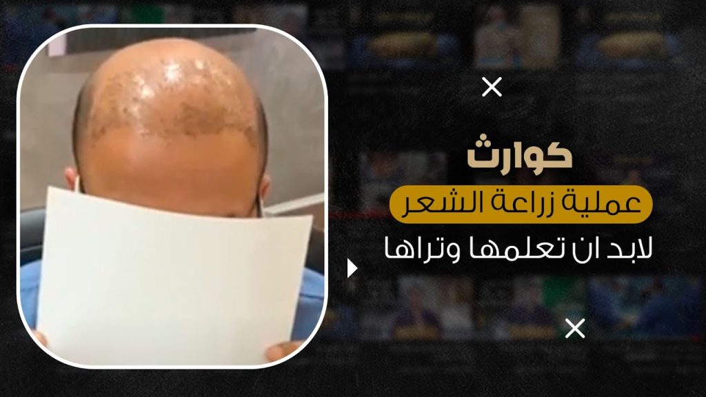 كوارث زراعة الشعر الطبيعي