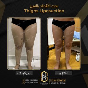 تجربتي مع الفيزر