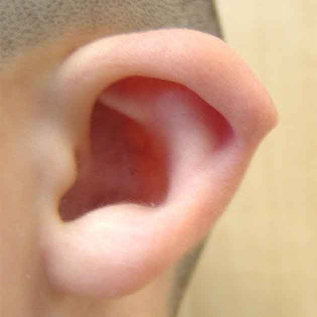 عملية تجميل الاذن