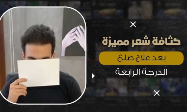 افضل علاج للصلع الوراثي