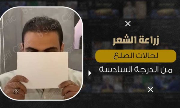 علاج صلع الشعر