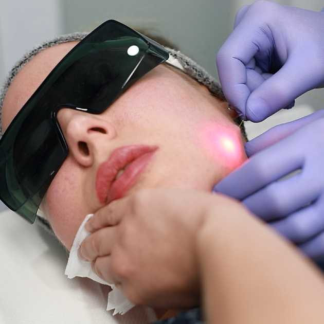 endolift