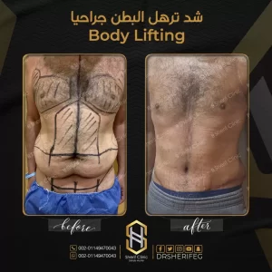 شد البطن بالجراحة