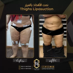 شفط دهون الأفخاذ