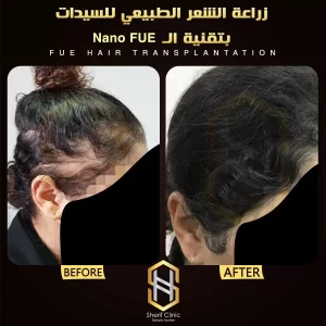 زراعة الشعر قبل وبعد للسيدات