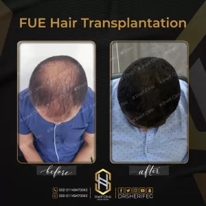 قبل وبعد زراعة الشعر بالاقتطاف