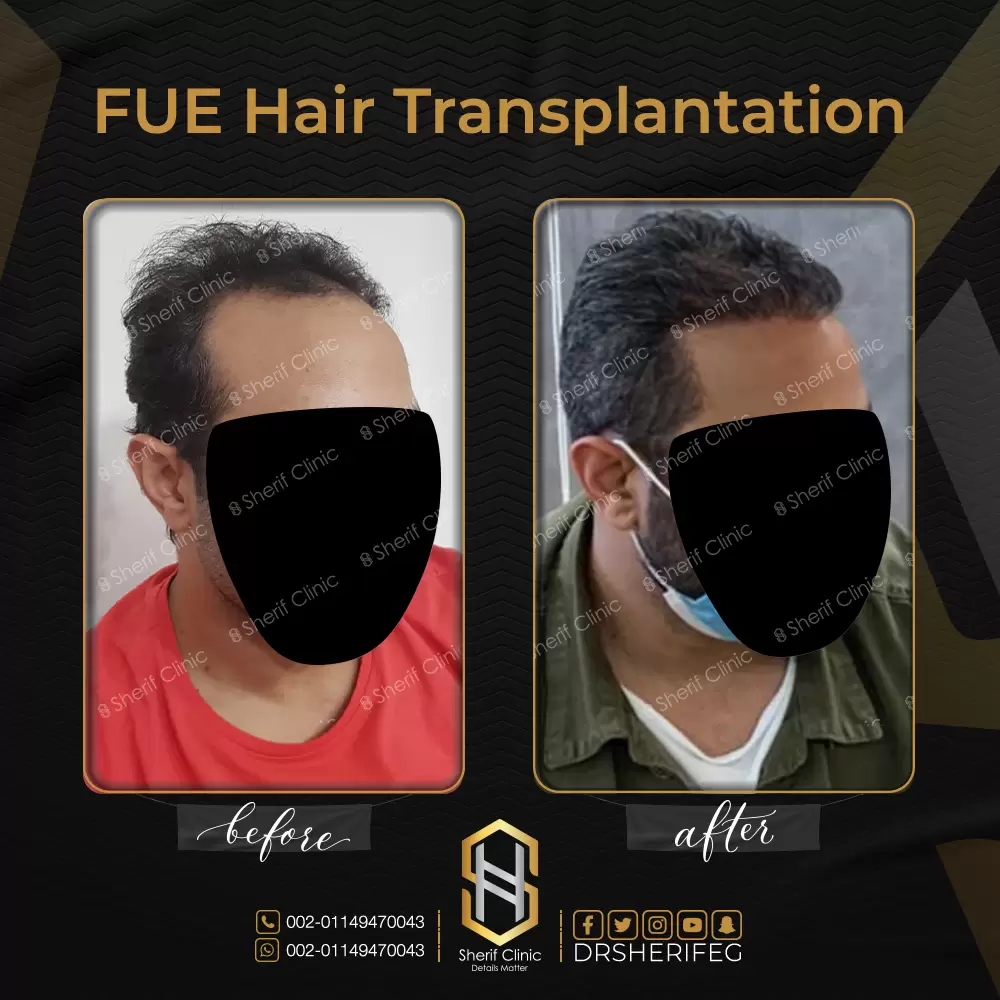 قبل وبعد زرع الشعر للرجال