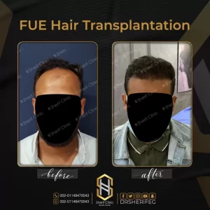 نتائج زراعة الشعر للرجال