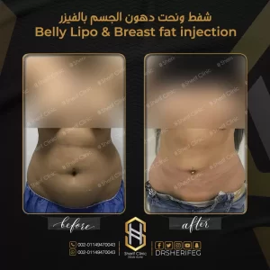 شفط ونحت دهون الجسم بالفيزر
