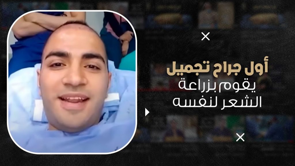 أول دكتور زراعة شعر يزرع لنفسه شاهد الفيديو من داخل العمليات