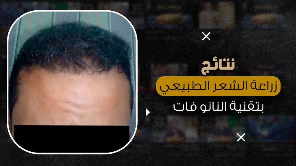 ماذا بعد زراعة الشعر بتقنية النانو فات