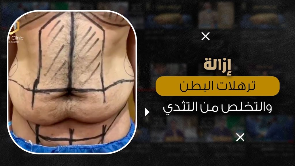 عملية شفط دهون البطن شاهد النتيجة مباشرة من داخل العمليات