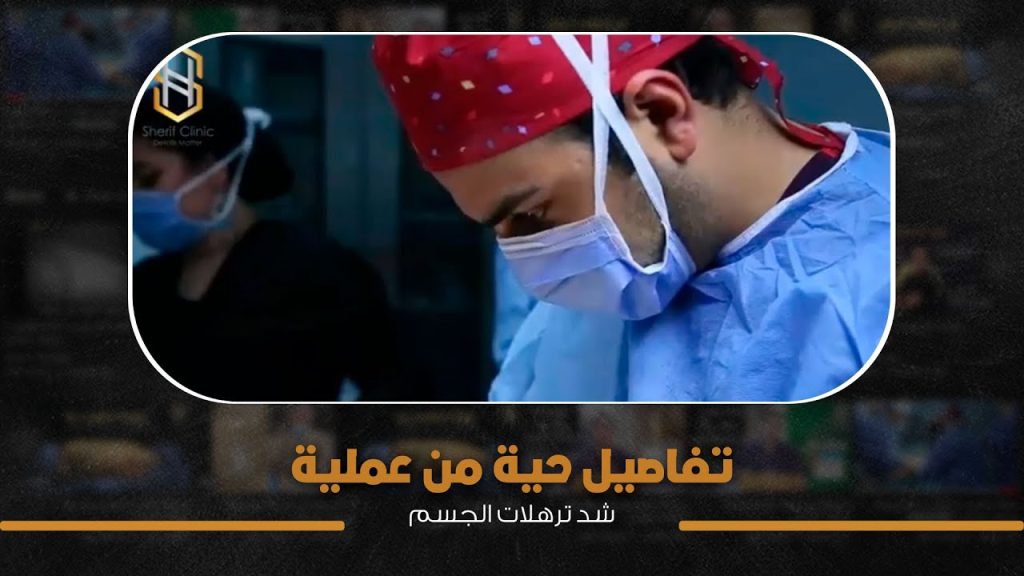 مباشرة شد ترهلات الجسم من داخل غرفة العمليات