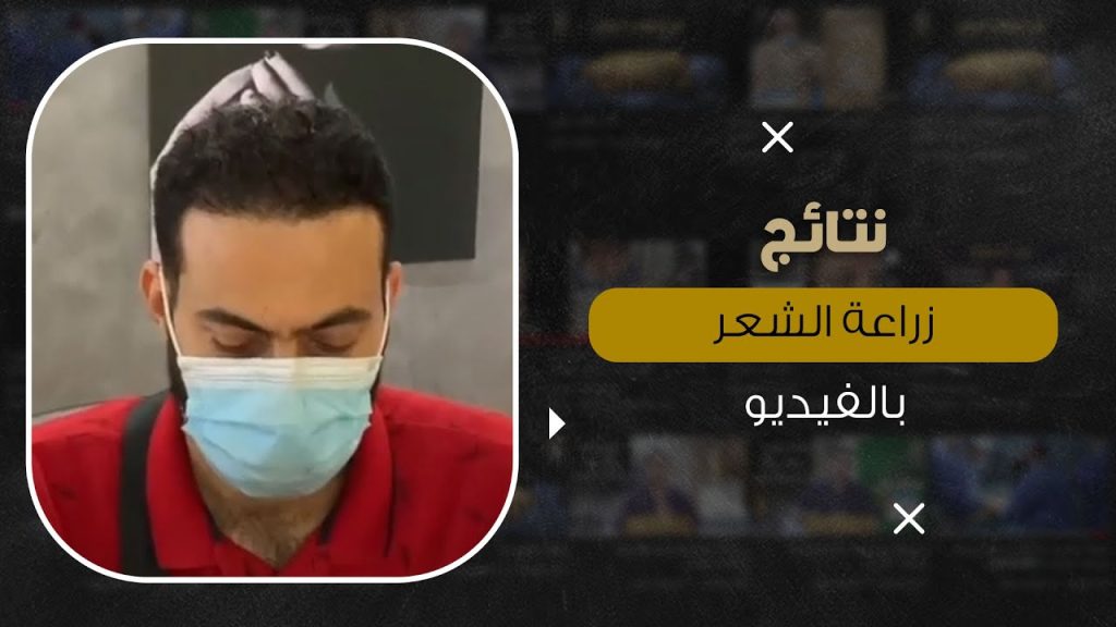 نتائج زراعة الشعر بالفيديو