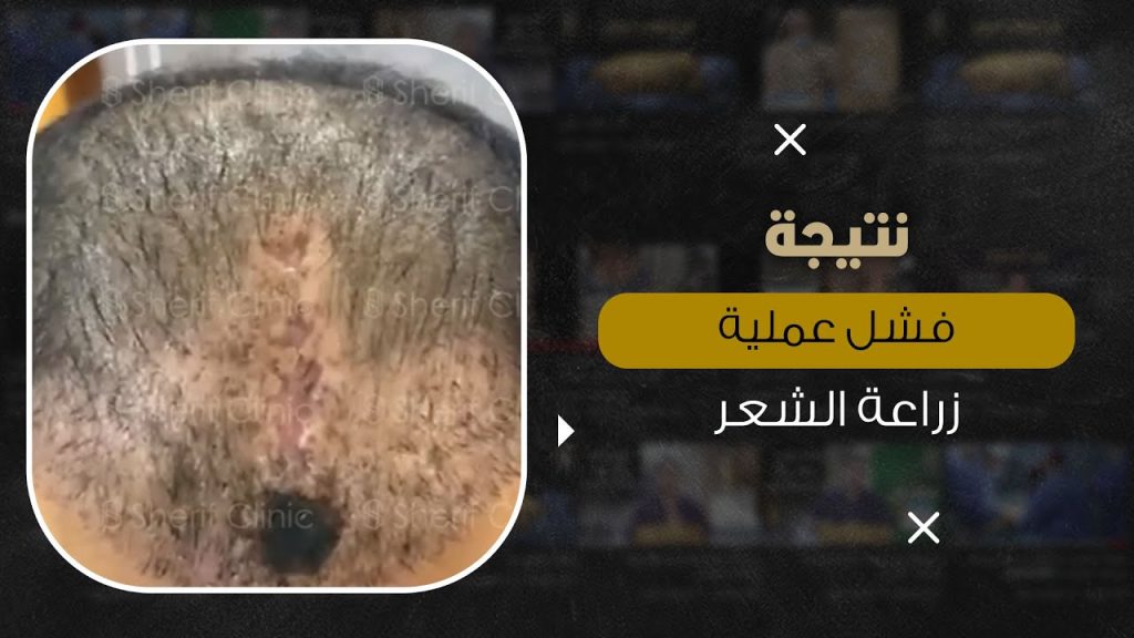 اصلاح عملية زراعة شعر فاشلة مباشرة
