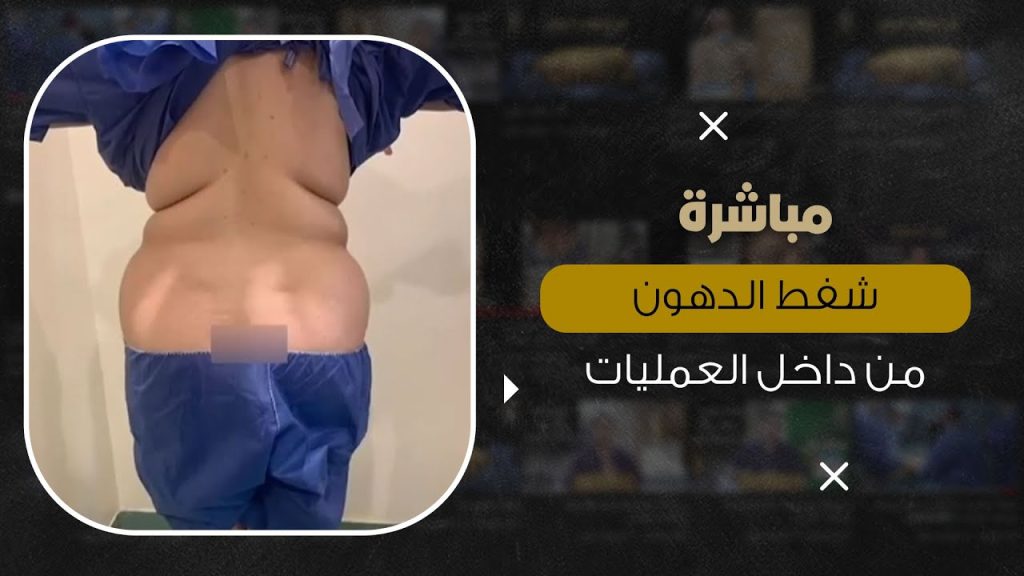 شفط الدهون مباشرة من داخل غرفة العمليات