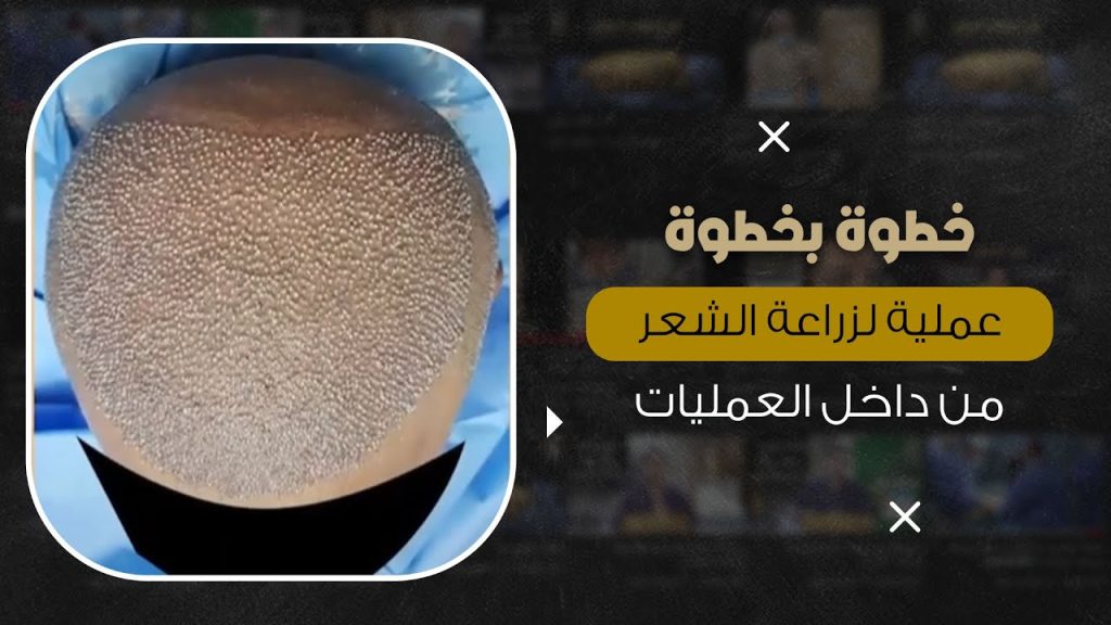 خطوة بخطوة عملية زراعة الشعر الطبيعي