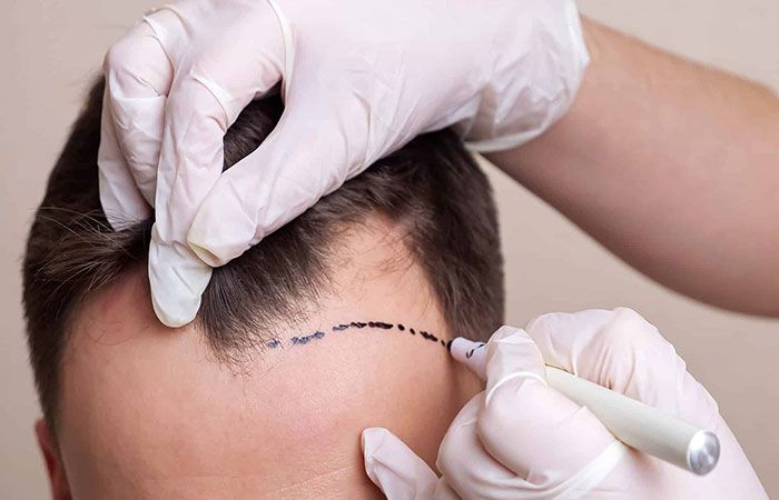 معلومات عن زراعة الشعر