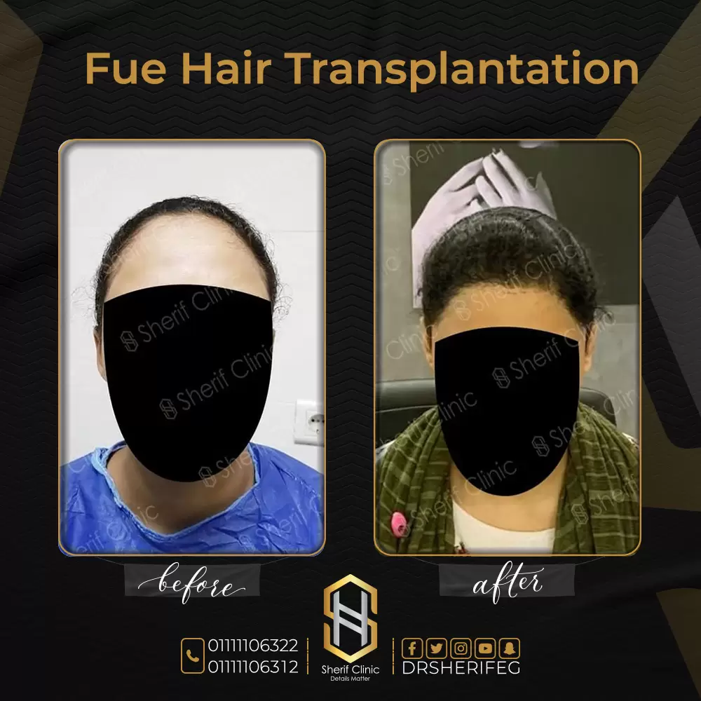 زراعة الشعر للنساء قبل وبعد