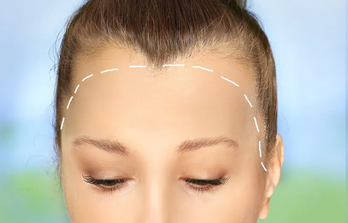 زراعة شعر الجبهة للنساء