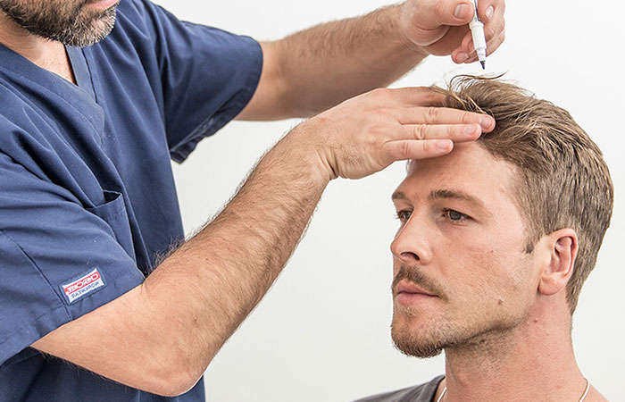 زراعة الشعر في تركيا