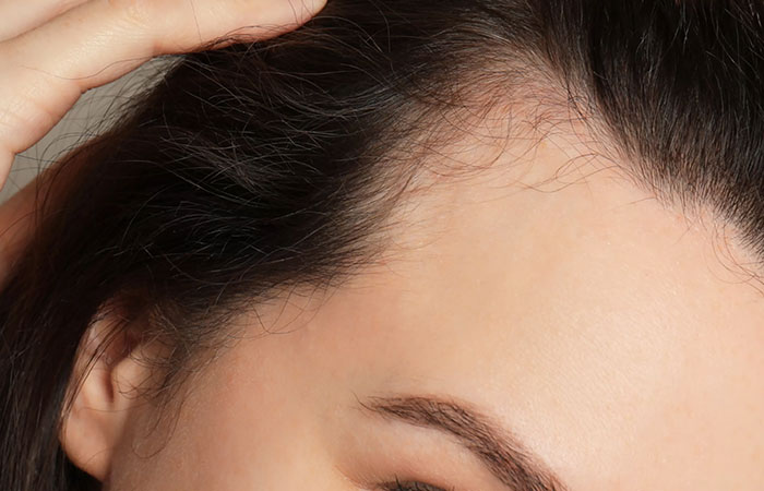 زراعة شعر الجبهة للنساء في مصر
